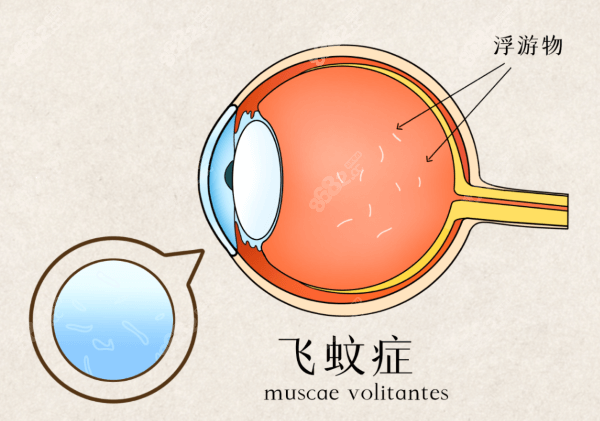 得了飞蚊症怎么治疗应该注意些什么