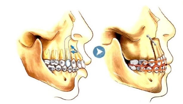 正颌手术