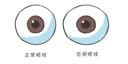 近视眼和正常眼球对比