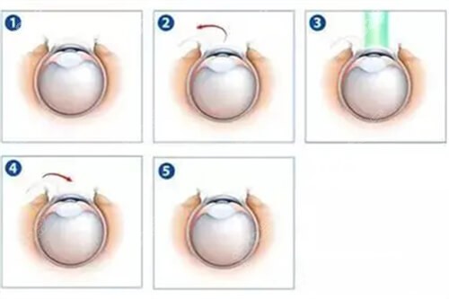 近视眼手术过程示意图