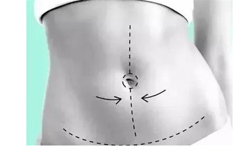 广州中家医朱云腹壁整形+隆胸组合,原疤痕切口出血少够平整