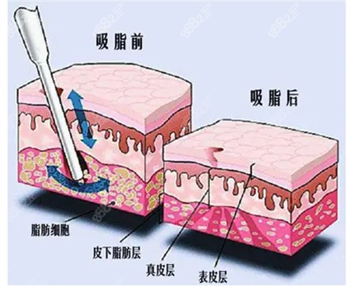 深圳曹孟君医生做吸脂手术技术很出色