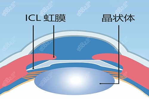 ICL晶体植入卡通图
