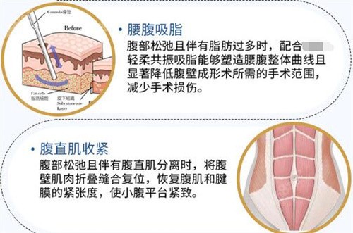 广州中家医腹壁整形方式