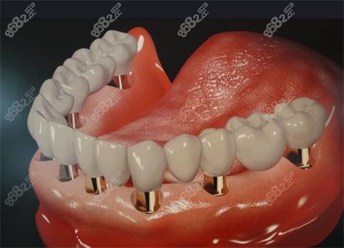 ​睢宁种植牙好的口腔诊所分享，均是当地人认准的好牙科