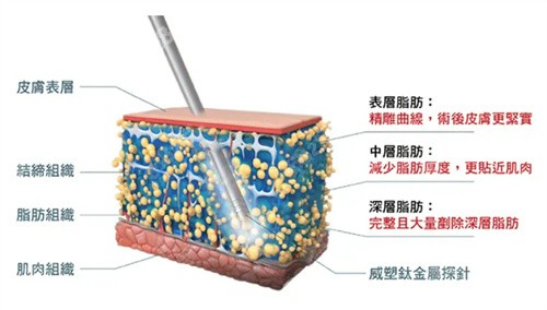 上海华美何斌医生的抽脂技术不错