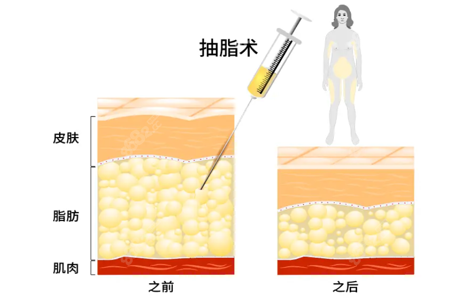 上海九院抽脂手术价格表:抽脂减肥价格3-10w|附吸脂医生推荐