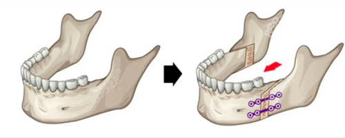 正颌手术移动改善