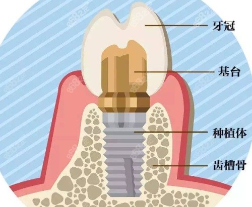 种植牙结构图