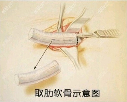 取肋軟骨隆鼻