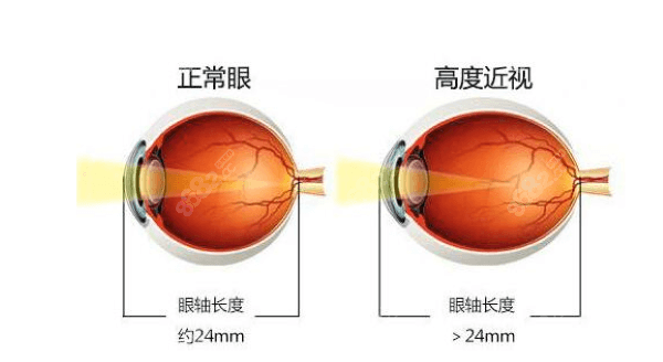 高度近视和正常眼的区别