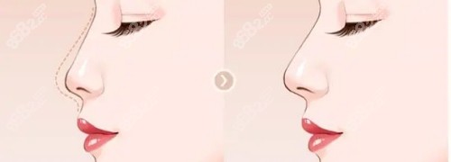 <!--<i data=20240705-sp></i>-->医生隆鼻多少钱？