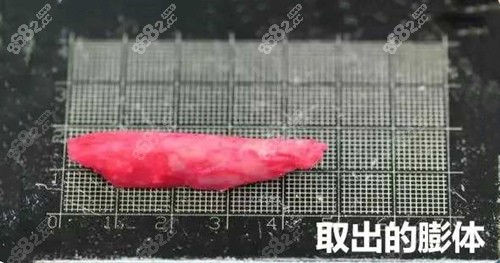 隆鼻假體膨體
