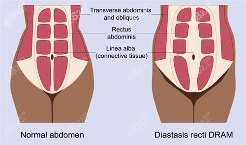 腹壁成形手术前后肌肉对比