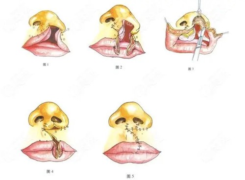 唇腭裂修复过程简易卡通示意图
