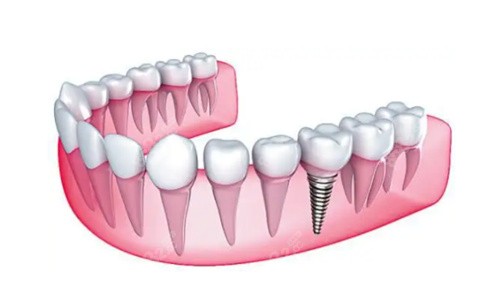 鹤壁植得口腔种植牙好不好