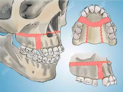 正颌凸嘴手术示意图