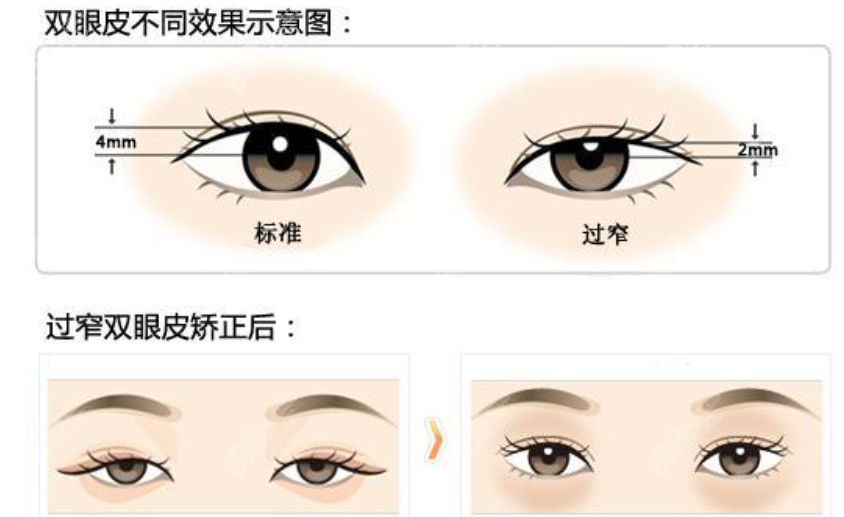 北京嘉禾李燕做双眼皮修复
