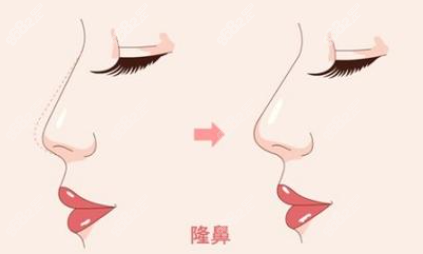 上海肋骨鼻價格