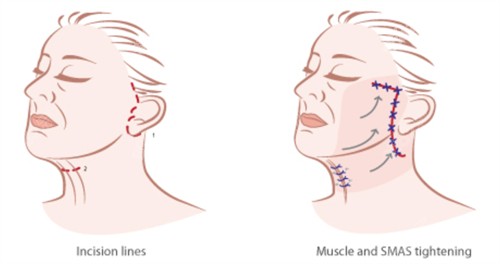 面部提升手术的切口和对比