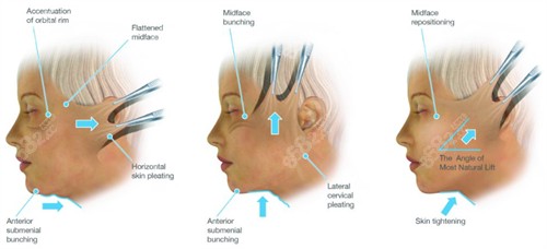 拉皮手术的不同提升角度
