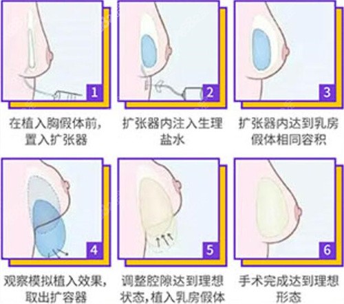 李高峰胸部整形扩容