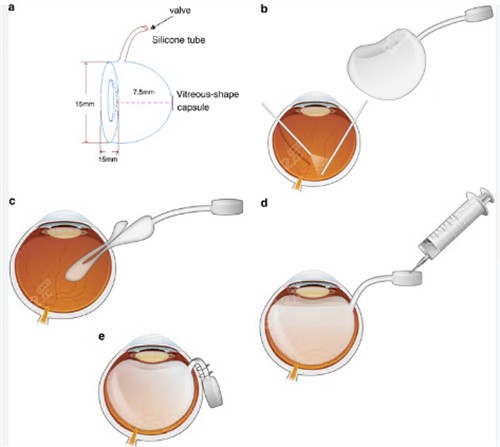人工玻璃体球囊植入术过程图