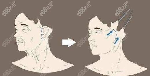 <!--<i data=20240705-sp></i>-->博士拉皮行