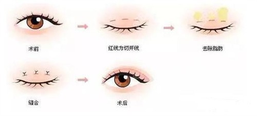 三点定位双眼皮手术过程