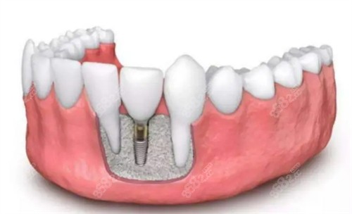 北京皓尔口腔做种植牙不错