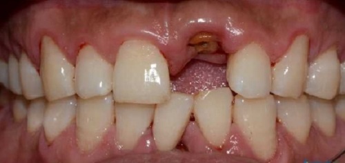 记录我9院种植牙全过程：赖红昌种牙挂号难但技术没得挑