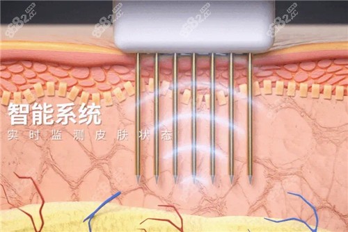 成都后美黄金微针活动