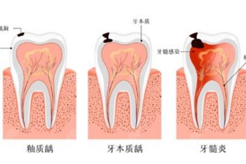 牙髓炎照片