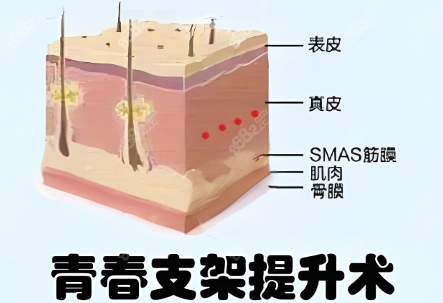 <!--<i data=20240705-sp></i>-->医生支架提升怎么样？