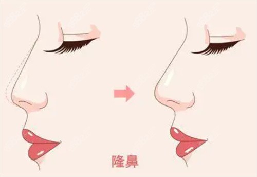 成都美辰星耀醫(yī)療美容醫(yī)院王宇琨醫(yī)生做鼻子多少錢？