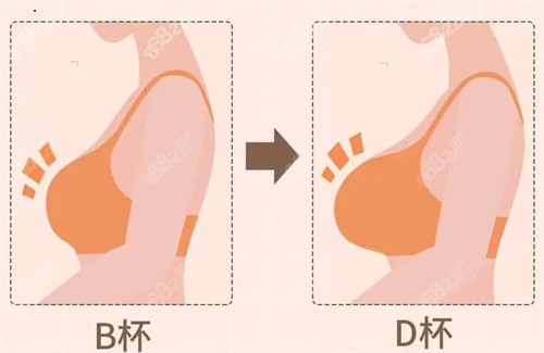 玻尿酸隆胸从a到b需要几只