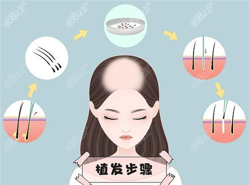 沈阳杏林整形医院植发多少钱？
