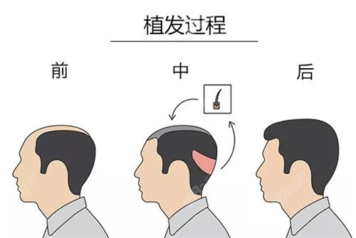 沈阳医院植发(沈阳正规医院植发)