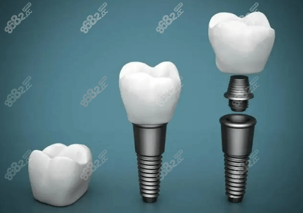 汕头奥诗卡口腔医院种植体正规