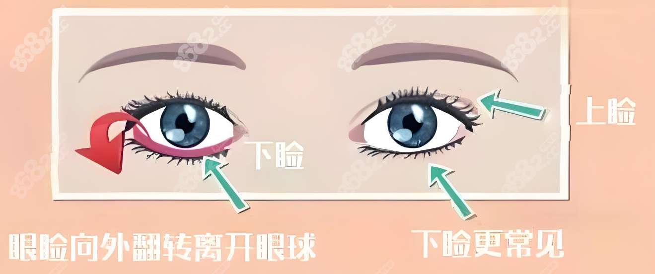 上海杜园园修复下眼睑退缩实例