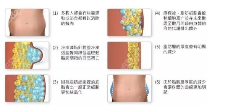 西安酷塑冷冻溶脂医院排名
