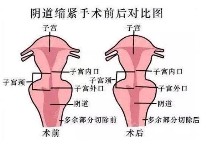 深圳整形医院私密手术