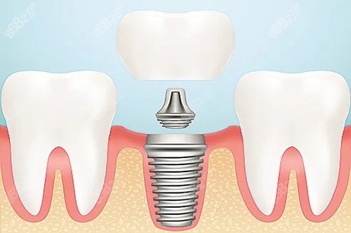 口腔种植牙卡通示意图.jpg