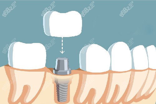 单颗种植牙牙冠安装漫画图.jpg