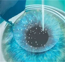 高度近视1000度可以做眼睛手术吗？激光|晶体植入都可做