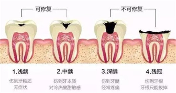 根管治疗