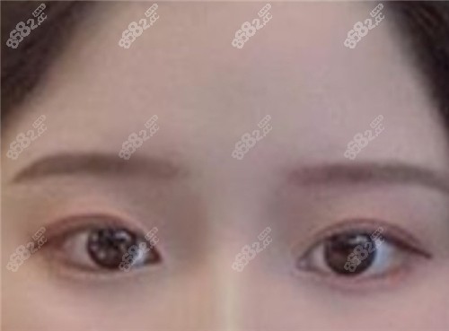 上海双眼皮修复术后图