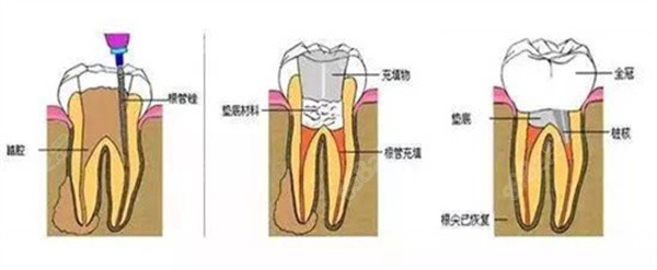 根管治疗