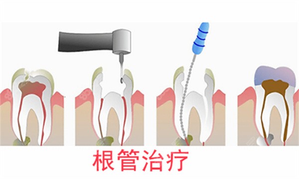根管治疗