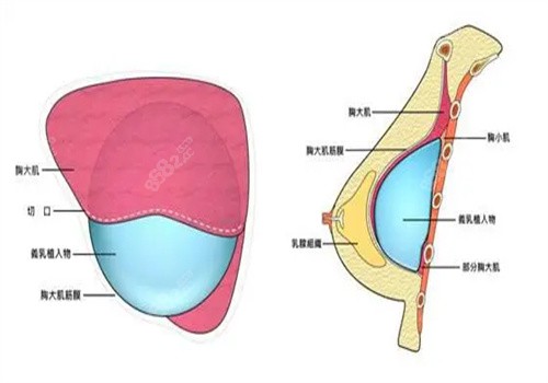 液态丰胸/胶原蛋白丰胸/自体脂肪丰胸区别.jpg
